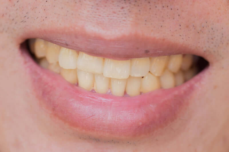 How to Prevent Your Teeth From Staining